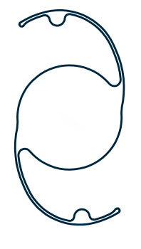 PMMA Sulcus Fixation